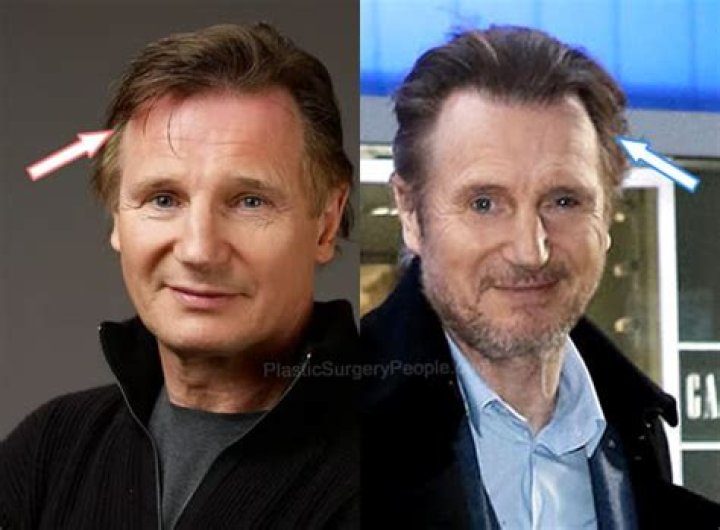 Does Liam Neeson Wear a Wig? Hair Transplant and Surgery Update