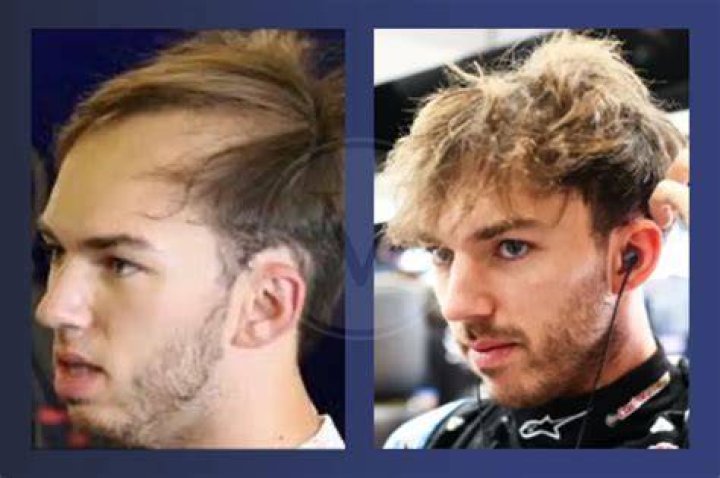 Is Pierre Gasly Bald Now? What Happened To His Hair? Health Update