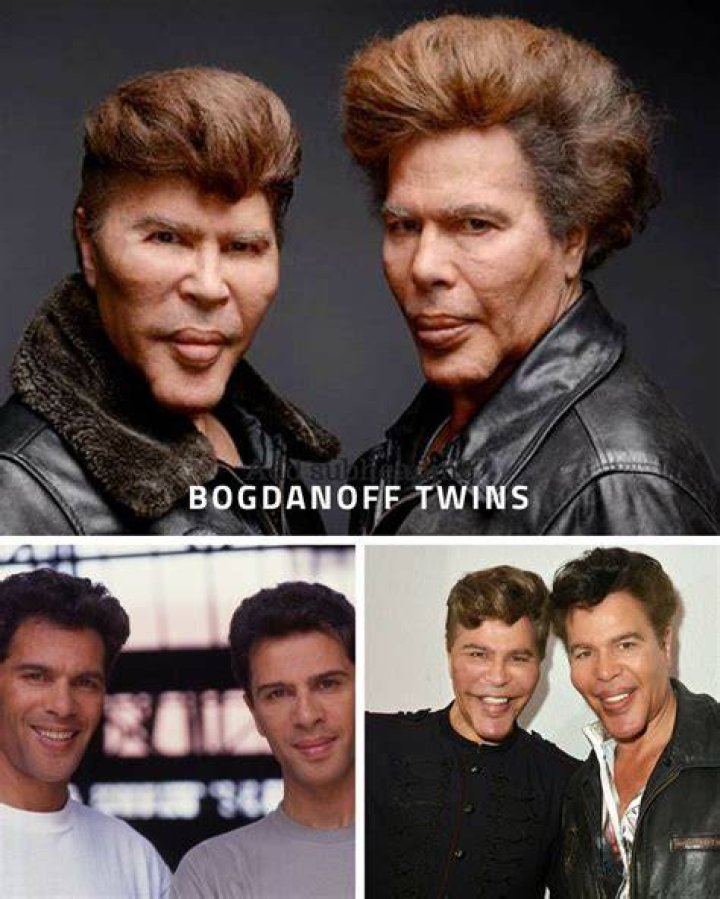 Why Did The Bogdanoff Twins Get Surgery And What Happened To Them? Before & After Pictures